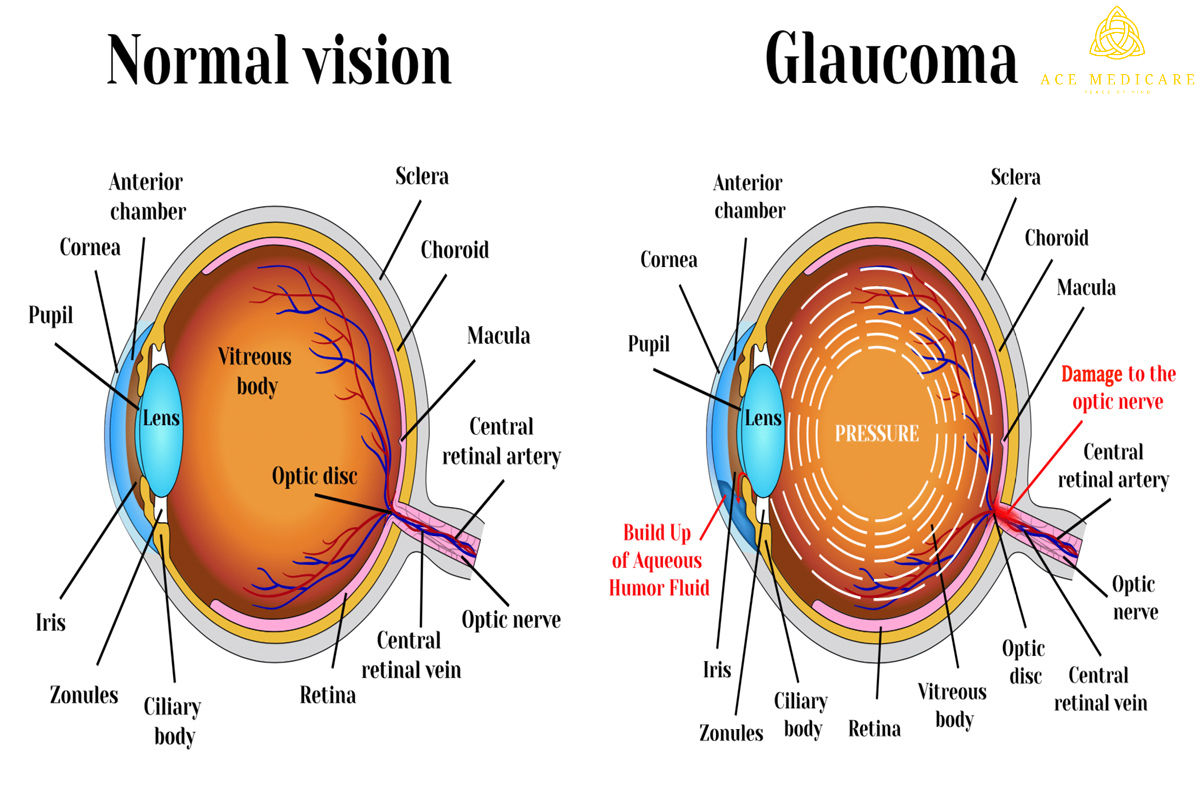 The Psychological Impact of Glaucoma: Coping Strategies and Support